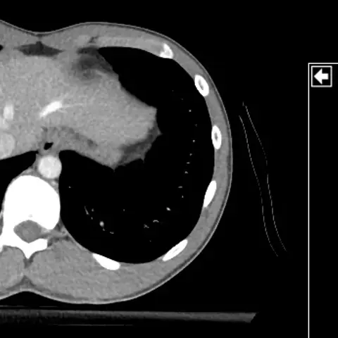 Axial contrast CT showing the liver, both lung bases, the aorta in front of a vertebra and the ribs, with a coronal reference image at the right.