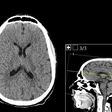 Axial CT of the head without contrast showing grey and white brain tissue, dark lateral ventricles in the middle and bright skull bone, with a small sagittal reference image at the lower right.