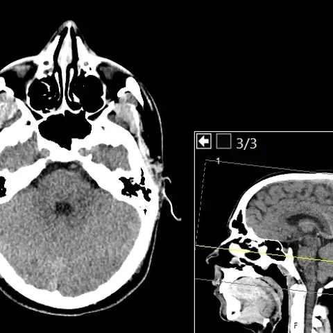 Axial CT through the lower head showing the nasal cavity and air-filled sinuses at the front, the cerebellum at the back and air cells of the mastoid on both sides.