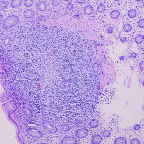 Micrograph of colon mucosa with regularly spaced pale crypts on the right and a dense blue-purple cluster of small cells just beneath the surface on the left.