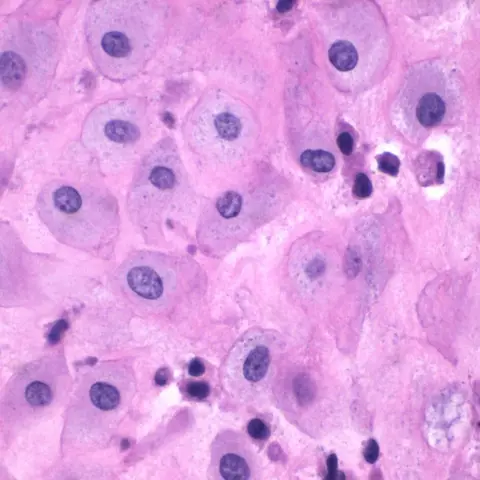 Micrograph of decidua with large polygonal cells that have abundant pink cytoplasm and round nuclei.