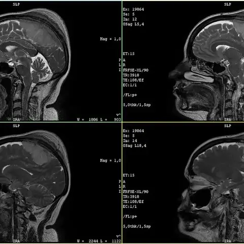 Four sagittal MRI slices of the head with the brain in grey, bright cerebrospinal fluid, the corpus callosum, the cerebellum and the brainstem, and text annotations from the scanner.