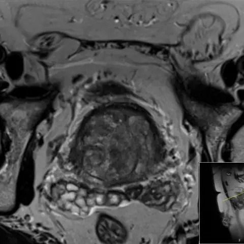 Axial T2-weighted MRI of the pelvis showing the femoral heads on both sides, pelvic organs in the middle and a small sagittal reference image at the lower right.