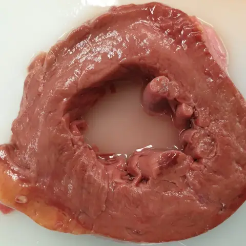 Photograph of a cross-section of the left ventricle of a heart, with a thick red-brown muscular wall around a central pale chamber and a darker area at the papillary muscle.
