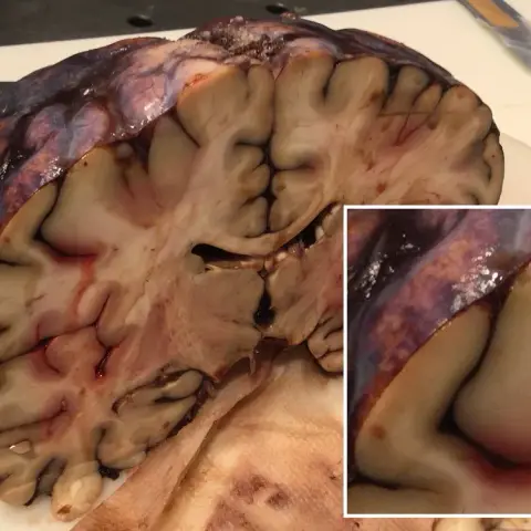 Photograph of a brain cut in a coronal section with dark blood over the surface and in the grooves, and a magnified inset at the lower right.