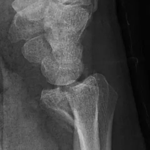 Lateral radiograph of a wrist showing the end of the radius and the carpal bones, with a fracture of the front rim of the radius.