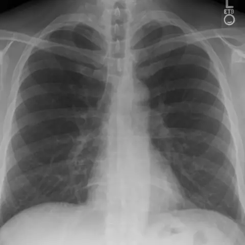 Posteroanterior chest radiograph of an adult, shown for practising a systematic review.