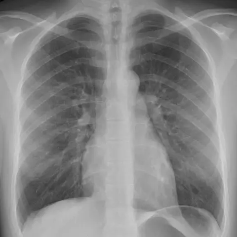 Posteroanterior chest radiograph of a young adult showing clear lungs, a normal-sized heart and sharp diaphragm outlines.