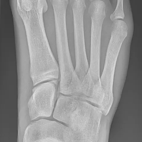 Dorsoplantar radiograph of a normal right foot showing the toes, metatarsals and tarsal bones.