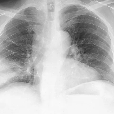 Posteroanterior chest radiograph with an area of increased whiteness in the lower part of the right lung, which is on the left of the image.
